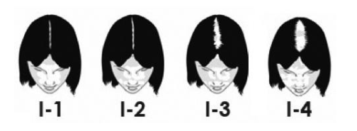 dr-aziza-calvitie-femme