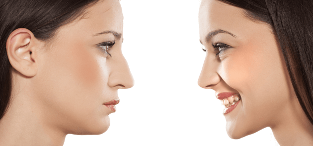 Rhinoplastie 1